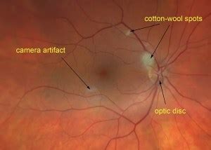 Cotton-Wool Spots - Scott E. Pautler, M.D. TampaScott E. Pautler, M.D ...