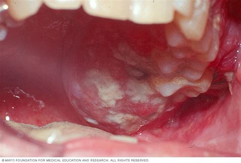 First Signs Of Mouth Cancer Pictures - CancerWalls