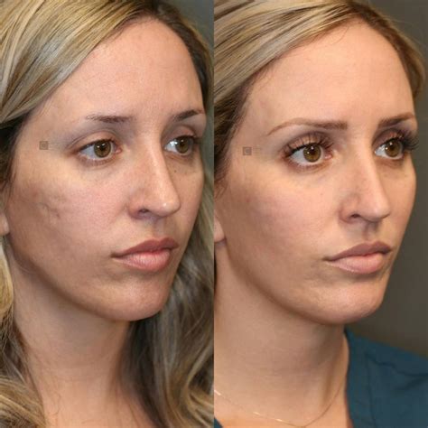 Patient 81572639 | Photodynamic Acne Scar Remodeling Before & After ...