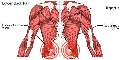 Lower Back Pain - The Complete Injury Guide - Vive Health