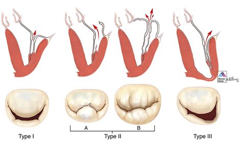 Myxomatous Mitral Valve Disease - Captions Beautiful