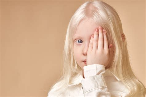 Experts Crack Breakthrough Human Model for Albino Eyes - PIE