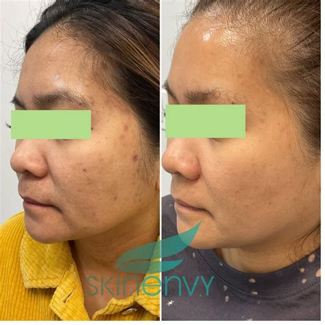 Laser Genesis Treatment In Brooklyn, NY | Skin Envy