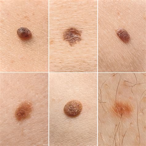 Understanding the different types of moles | Spot Check Clinic