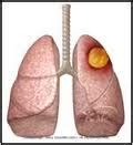 Lung Abscess-Treatment-Causes-Signs and Symptoms