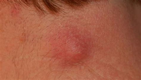 Skin Cancer Most Common Country : Lump on neck: Causes and pictures ...