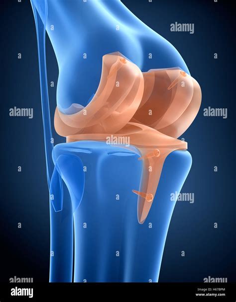 Knee and titanium hinge joint. X-ray view. 3D illustration Stock Photo ...