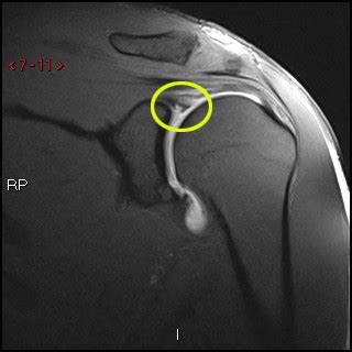 MRI Arthrogram Shoulder: Rule Out Labral Tear | Cedars-Sinai