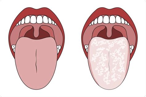 Oral Candidiasis Treatment