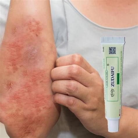 Rash 22 common skin rashes pictures causes treatment – Artofit