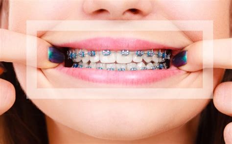 Blue Braces: How do you pick the right color?!