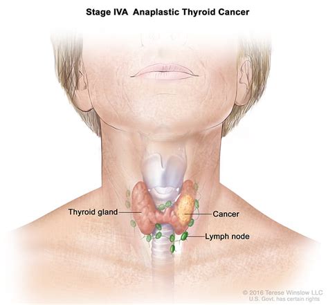 Thyroid Cancer Staging | RMCC