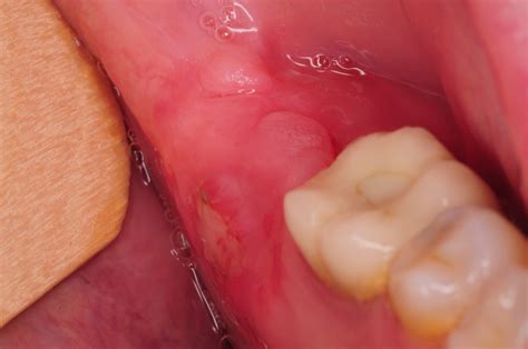 Infection one month after wisdom tooth extraction | healthlines