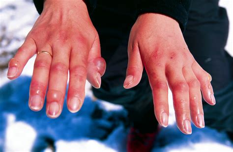 File:Frostbitten hands.jpg - Wikimedia Commons