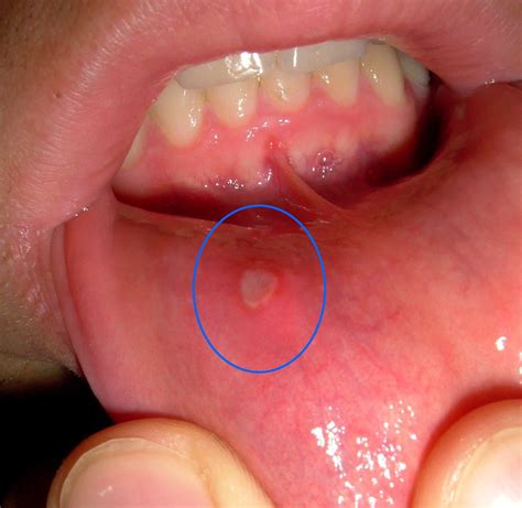 What causes mouth sores