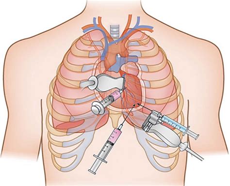 Pericardial Window Procedure Steps