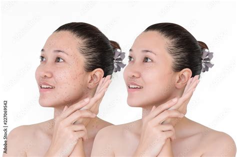 Before and after laser treatment Stock Photo | Adobe Stock