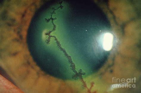 Dendritic Ulcer (herpes Simplex) On Cornea Of Eye by Argentum/science ...