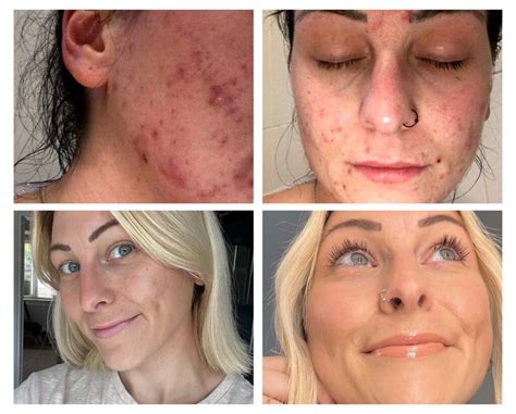 Skin + Me Stories: Before and After Acne with Jessica Holt – The Dose