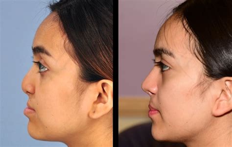 Cleft lip revision, rhinoplasty can restore confidence for teens and ...