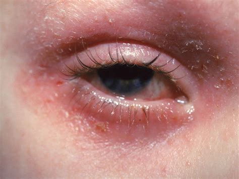 Eyelid dermatitis causes, symptoms, diagnosis & treatment