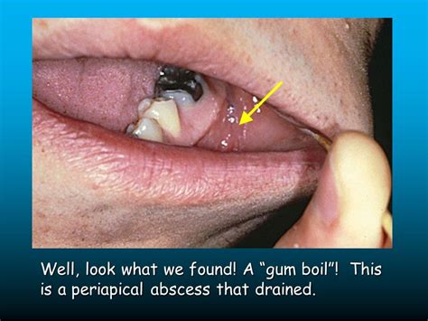 Tooth Abscess Swollen Cheek