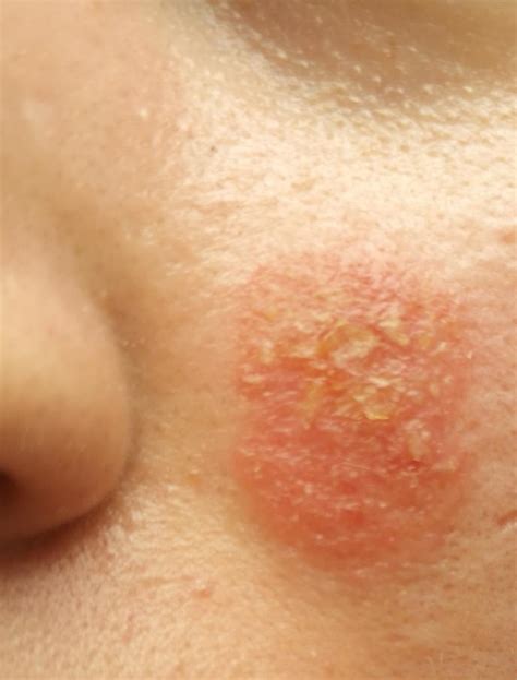 Red spots : r/Rosacea