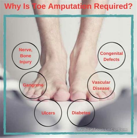 Toe Amputation Surgery Abroad