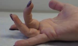 Trigger Finger Surgery Cost | Complications | Recovery - Sutured