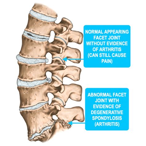 Cervical Facet Syndrome - The Orthopedic Pain Institute, Beverly Hills ...