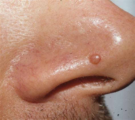 Papules On Face