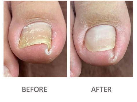 cost of ingrown toenail removal - zollinger-kemme