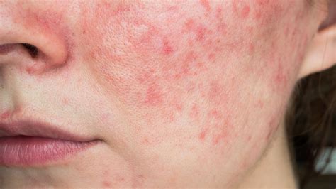 What Is Rosacea? Causes, Symptoms, Treatment, and Prevention - GoodRx