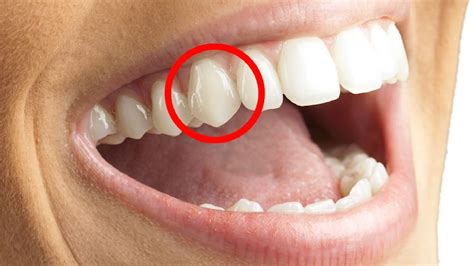 Why Do Some People Have “Vampire Teeth” & Can It Be Fixed? | SYOK