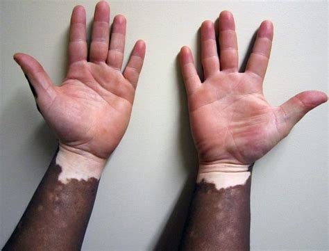 Vitiligo, causes and treatment