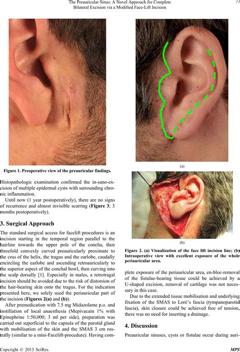 preauricular cyst excision