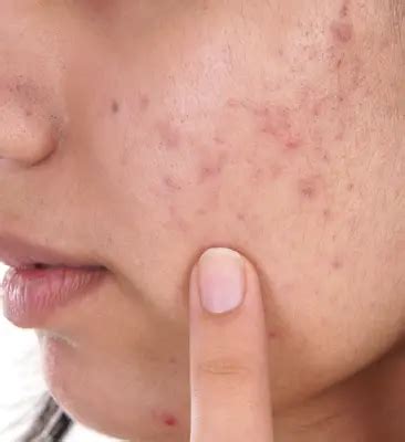 Keloids Acne