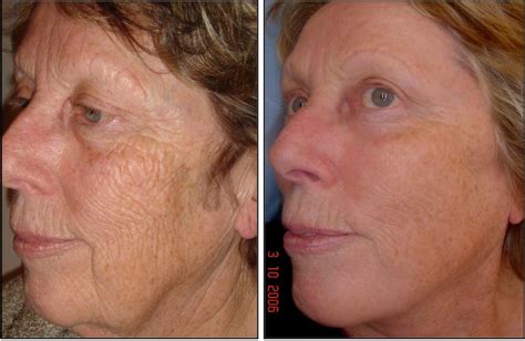 Laser Surgery: Laser Surgery Laser Treatment Laser Laser Skin Resurfacing