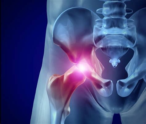 hip-bursitis - Laser Pain Therapy