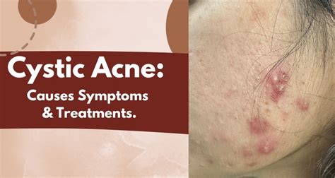 Cystic Acne: Causes, Symptoms and Treatment | Dr. Pallavi Sule