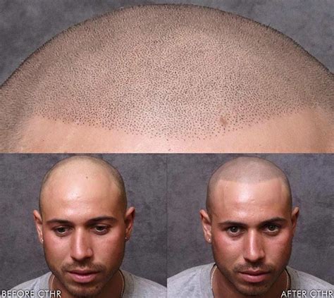 tattoo on head for hair loss - narayan-ela