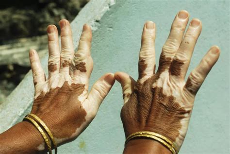 What are the types of vitiligo?