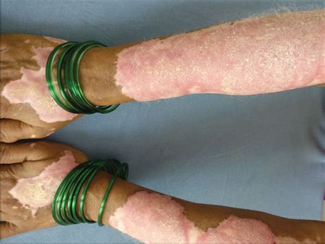 Colocalisation of subacute cutaneous lupus erythematosus and vitiligo ...