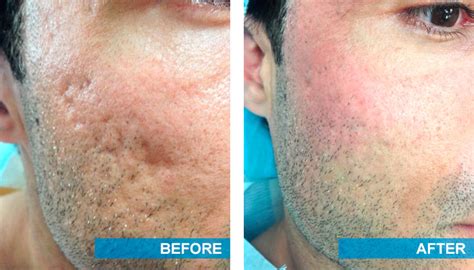 Regaining Confidence With Acne Scar Treatment | Dermatology Consultants ...