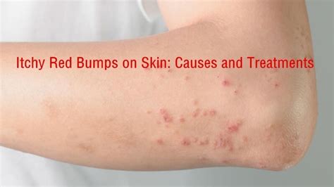 Common Causes Of Itchy Red Bumps And Skin Rashes Severe Itchy | Sexiz Pix