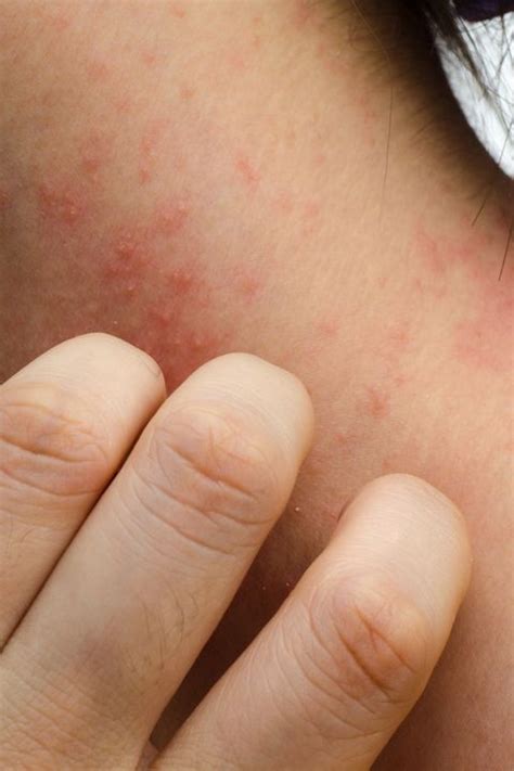 The 6 Most Common Types of Eczema — And How to Treat Them - Kinds of ...