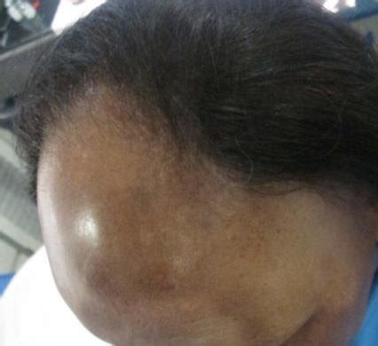 Frontal fibrosing alopecia (Pre-treatment). | Download Scientific Diagram