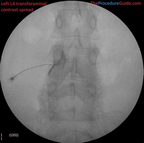 Fluoroscopic Guided Thoracic/Lumbar Transforaminal Epidural Steroid ...