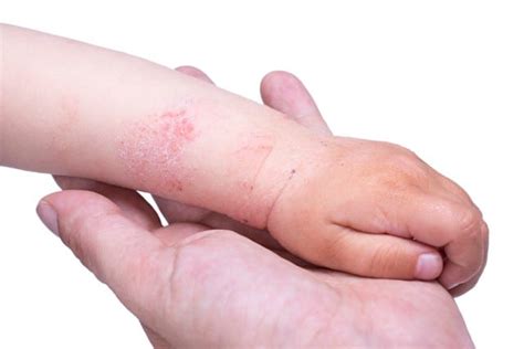 Children's Eczema Treatment Miami | Certified Dermatologists