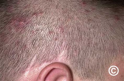 Mild Folliculitis Scalp Treatment